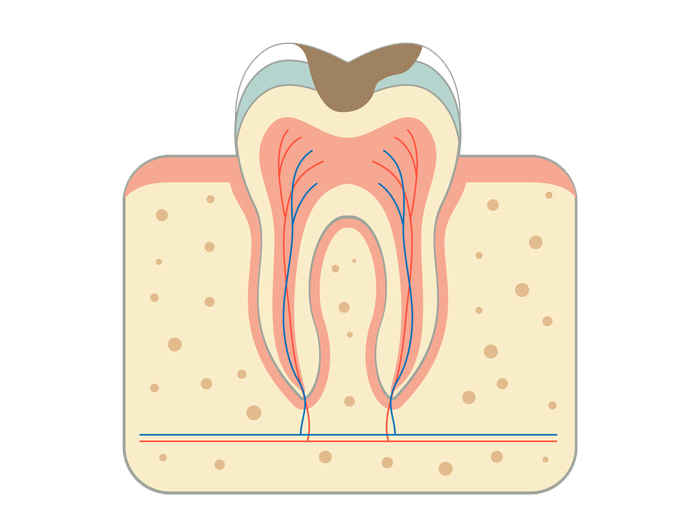 Endodontic disease