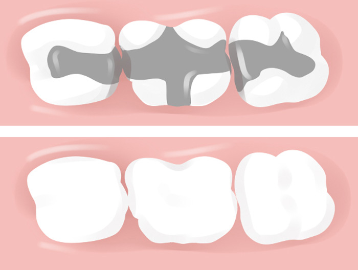Inlays and onlays fillings before and after vector