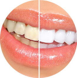 Teeth whitening with mirror